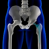 hip_replacement