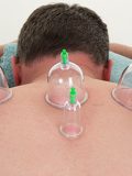 cupping therapy